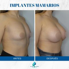 Aumento Mamario - Dr. Rodolfo Villavicencio