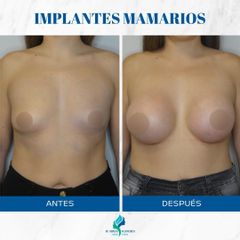 Aumento Mamario - Dr. Rodolfo Villavicencio