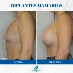 Aumento Mamario - Dr. Rodolfo Villavicencio