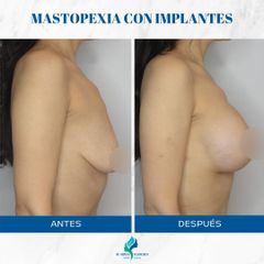 Mastopexia con implantes - Dr. Rodolfo Villavicencio
