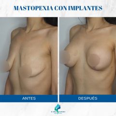 Mastopexia con implantes - Dr. Rodolfo Villavicencio