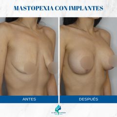 Mastopexia con implantes - Dr. Rodolfo Villavicencio