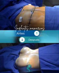 Aumento Mamas - Dr. Rodolfo Villavicencio