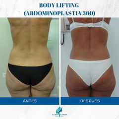 Abdominoplastia 360 - Dr. Rodolfo Villavicencio