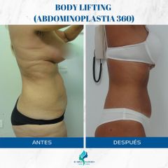 Abdominoplastia 360 - Dr. Rodolfo Villavicencio