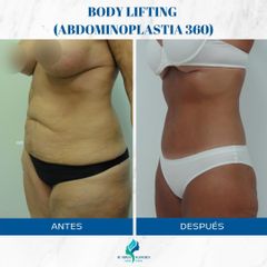 Abdominoplastia 360 - Dr. Rodolfo Villavicencio