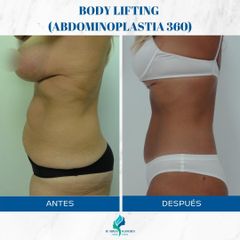 Abdominoplastia 360 - Dr. Rodolfo Villavicencio