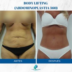 Abdominoplastia 360 - Dr. Rodolfo Villavicencio