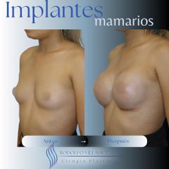 Aumento Mamas - Dr. Rodolfo Villavicencio
