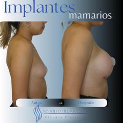 Aumento Mamas - Dr. Rodolfo Villavicencio