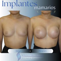 Aumento Mamas - Dr. Rodolfo Villavicencio