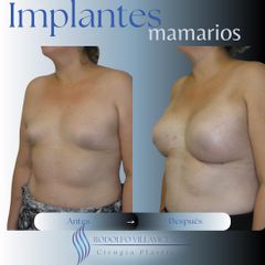 Aumento Mamas - Dr. Rodolfo Villavicencio