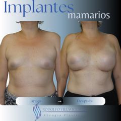 Aumento Mamas - Dr. Rodolfo Villavicencio