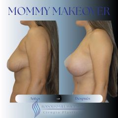 Mastopexia - Dr. Rodolfo Villavicencio