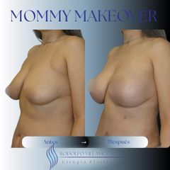 Mastopexia - Dr. Rodolfo Villavicencio