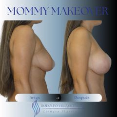 Mastopexia - Dr. Rodolfo Villavicencio