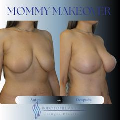 Mastopexia - Dr. Rodolfo Villavicencio