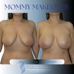 Mastopexia - Dr. Rodolfo Villavicencio