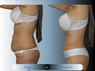 Abdominoplastía antes y después - 874401