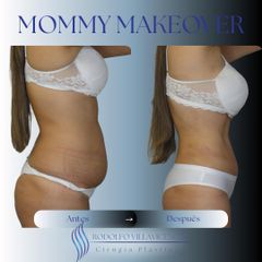 Abdominoplastia - Dr. Rodolfo Villavicencio