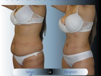 Abdominoplastía antes y después - 874403