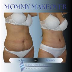 Abdominoplastia - Dr. Rodolfo Villavicencio