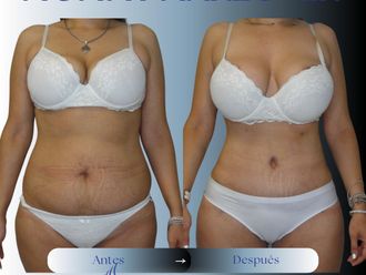 Abdominoplastía antes y después - 874405