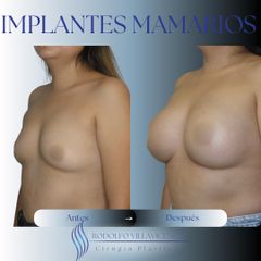 Aumento Mamario - Dr. Rodolfo Villavicencio