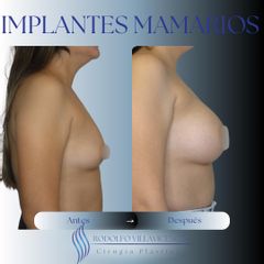 Aumento Mamario - Dr. Rodolfo Villavicencio