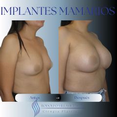 Aumento Mamario - Dr. Rodolfo Villavicencio