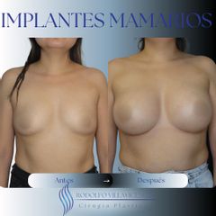Aumento Mamario - Dr. Rodolfo Villavicencio