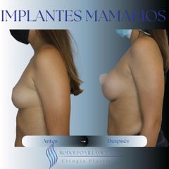 Aumento Mamario - Dr. Rodolfo Villavicencio