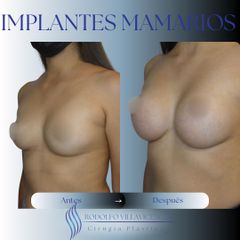 Aumento Mamas - Dr. Rodolfo Villavicencio