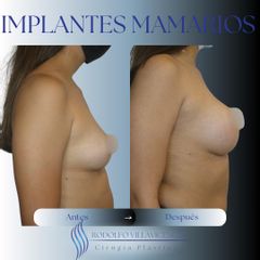 Aumento Mamas - Dr. Rodolfo Villavicencio
