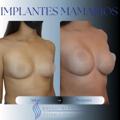 Aumento Mamas - Dr. Rodolfo Villavicencio