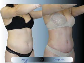 Abdominoplastía antes y después - 875180