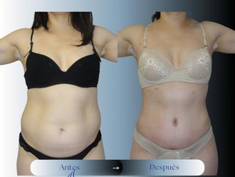 Abdominoplastía antes y después - 875181