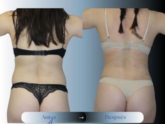 Liposucción antes y después - 875182