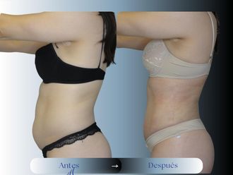 Liposucción antes y después - 875183