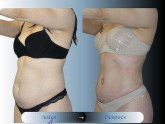 Liposucción antes y después - 875184