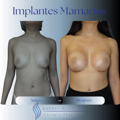 Aumento Mamas -Dr. Rodolfo Villavicencio