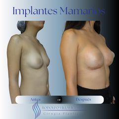 Aumento Mamas -Dr. Rodolfo Villavicencio