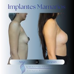 Aumento Mamas -Dr. Rodolfo Villavicencio