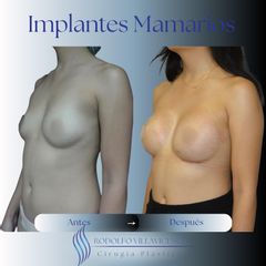 Aumento Mamas -Dr. Rodolfo Villavicencio