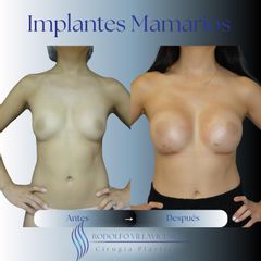 Aumento Mamas -Dr. Rodolfo Villavicencio
