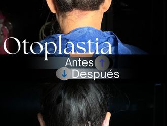 Otoplastia antes y después - 875640