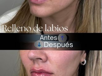 Relleno de labios antes y después - 875785