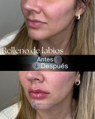 Relleno  de Labios - Dr. Rodolfo Villavicencio