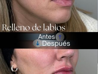 Relleno de labios antes y después - 875786