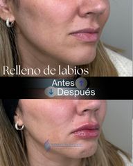 Rellenos de Labios - Dr. Rodolfo Villavicencio